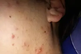 皮肤科医生最喜欢的痘痘图片