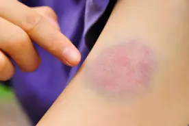 为什么会淤青呢？图片