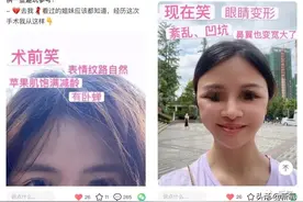 从果汁脸到凹坑怪人，花5万拉皮的我就这样毁容了…图片