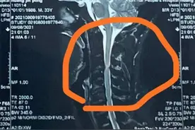 作为一名脊椎保守治疗的医生劝病人做手术的全过程图片