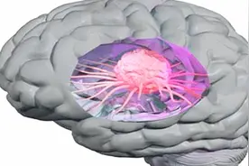 脑胶质瘤能治好吗？医生实话实说！视频封面