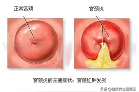 人体健康之急性子宫颈炎图片