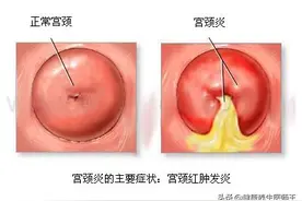 人体健康之急性子宫颈炎图片