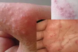夏季，手上长出"小水泡"，又痒又痛，可能是身体在暗示，莫忽视图片