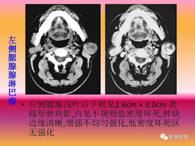 腮腺角化型鳞癌