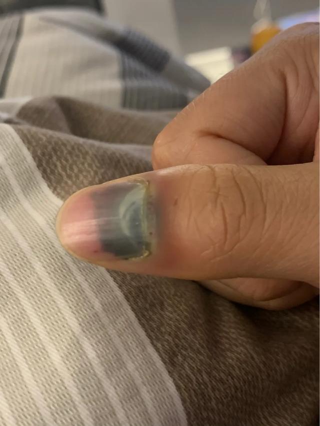指甲盖被砸了有瘀血怎么办