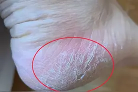 脚后跟经常起皮开裂，是缺乏维生素吗？原因不止一种，对照检查图片