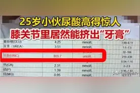 25岁小伙得痛风膝盖挤出牙膏？不爱喝酒却得痛风？中医理论解读图片