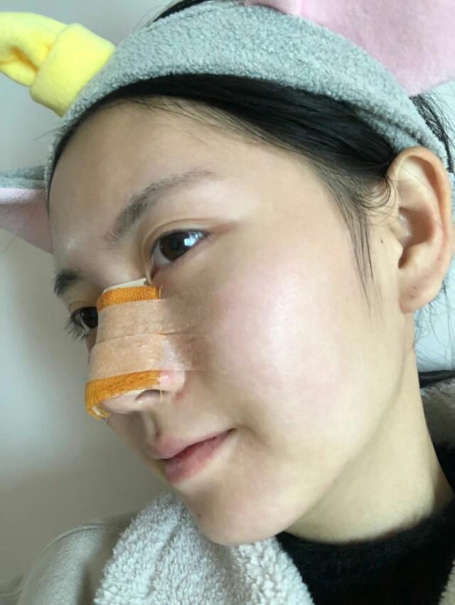 即上述两种都有-今天给大家分享做鼻子案例的伙伴就属于第16615种