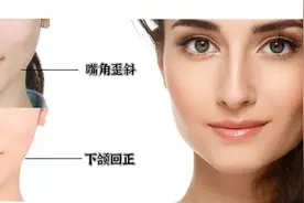 面部的21天改善后，下颌回正了、面部对称了，笑起来更好看了图片