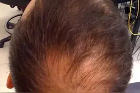 疫苗副作用？新加坡大叔称接种后惨变秃头图片