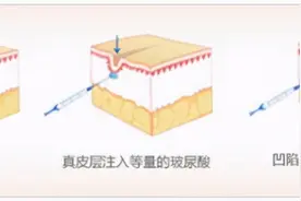整形医院的玻尿酸的作用都有哪些？图片