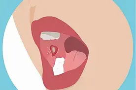 口腔溃疡反反复复，专家说内治虚火是关键，推荐一款“甘露饮”图片