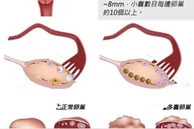 多囊卵巢综合征的致病原因是什么，有什么危害？图片