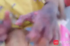7岁男童被父亲烟头烫伤，双手面临截肢！他说不讨厌爸爸图片