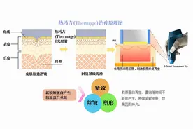 北京联合丽格：热玛吉四代和五代有什么区别？做哪个才适合？图片