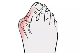 常见的足部畸形——拇外翻图片