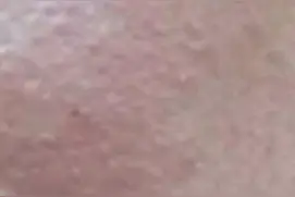 脸痒烧灼感三天图片