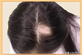 一觉睡醒头发没了，听说是“鬼剃头”？别怕！这里有驱“鬼”妙招图片