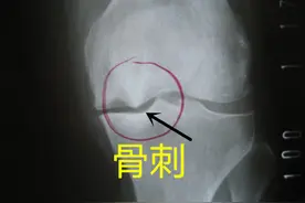 骨刺是如何形成的？长了骨刺怎么办？需不需要治疗？此文告诉你图片