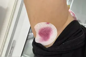 腋下黑刷酸一个月图片