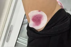 腋下黑刷酸一个月图片