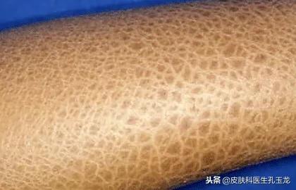 腿上有鱼鳞一样怎么回事 腿上有鱼鳞一样怎么回事