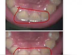 洁牙后，牙齿出现黑斑，是蛀牙了吗？再也不去洁牙了图片