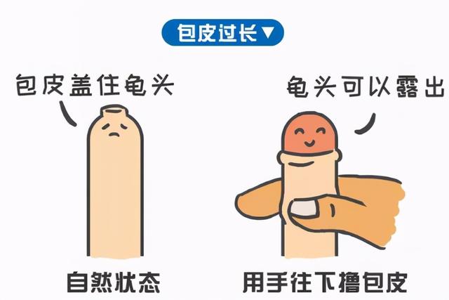 都成年了,还需要割包皮吗?