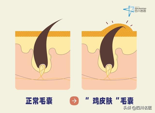 屁股下方皮肤摸起来像鸡皮肤