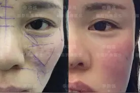 值得收藏！关于自体脂肪填充，那些整形医生不会告诉你的图片