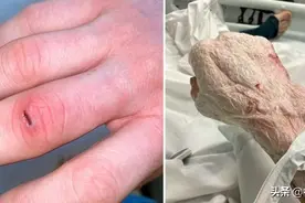 手指划了个小口子 英国男子整只手溃烂图片