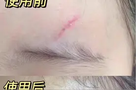 什么是“疤痕凝胶”，真的有效果吗？图片