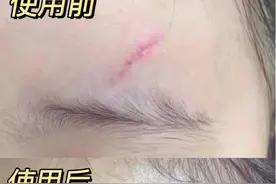 什么是“疤痕凝胶”，真的有效果吗？图片