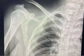 骨二科‖全市首例开展肩锁关节脱位铆钉修复术图片