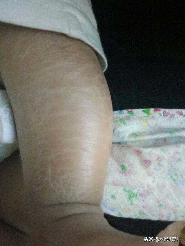 婴儿大腿鸡皮疙瘩