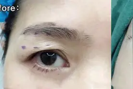 40-50岁上眼皮耷拉、三角眼，做个提眉术能改善到什么程度？图片