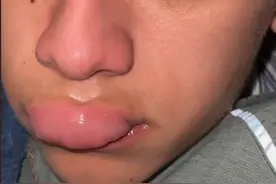 帅气小哥惨被黄蜂蜇！记录3小时变化，烈焰红唇笑傻千万网友图片