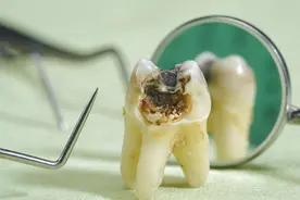 补牙“油水”有多大？补牙前，请一字不漏地看完图片