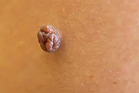 男子因脚底一颗痣遭截肢：身体上有这5种痣，一定要注意图片