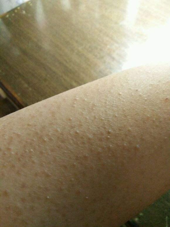 毛周角化症年龄大