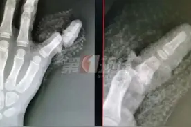 紧急求救！4岁女童手指被夹断！家中这个细节务必注意图片