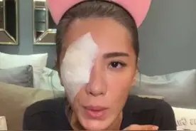 胡瓜女儿右眼受伤缠上纱布，却被质疑割双眼皮，回击：谁只割一边图片