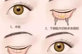 眼袋也分真假，不是所有眼袋都要手术图片