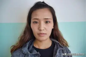 做了全脸脂肪填充后，一张"成熟脸"进阶"初恋脸"图片