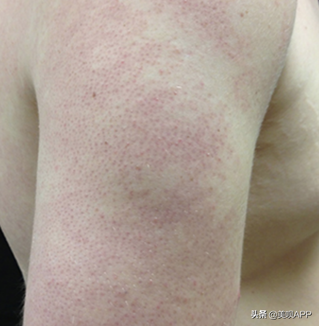 毛周角化会有黑点吗