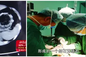 7岁女孩腹痛难忍呕吐不止，医生一查瞬间惊了胃里全是头发视频封面
