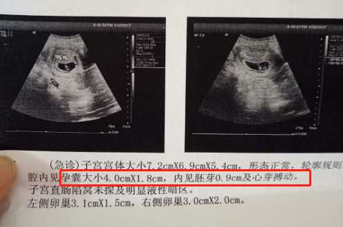 孕酮低怎么办、如何看是否胎停？怀孕早期四个常见问题，收藏学习