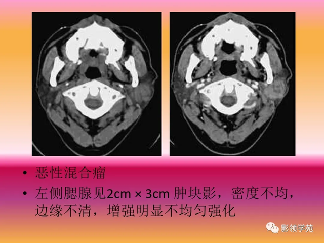 腮腺角化型鳞癌