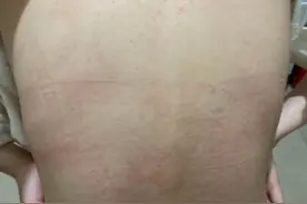 密集恐惧症！女子在“巴渝风”做完精油开背后，瘙痒难耐一片红点图片